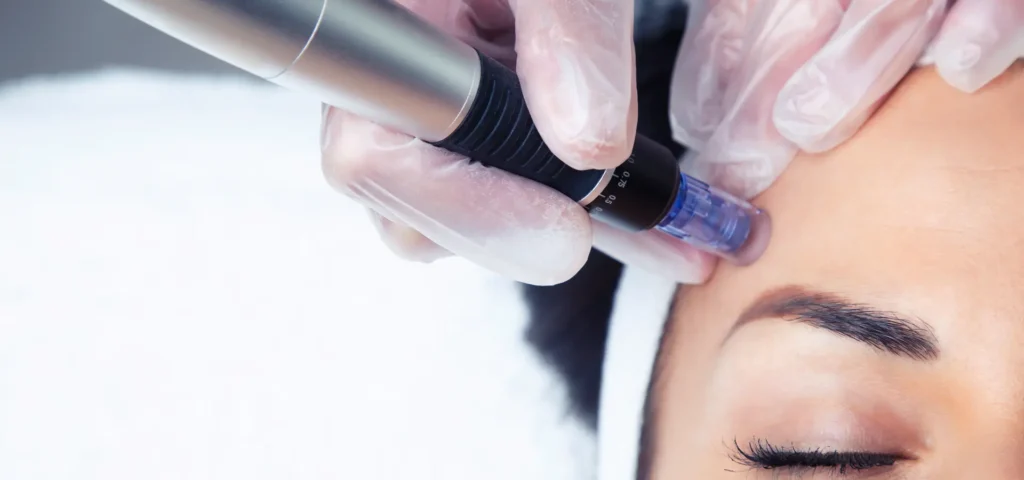 resultados dermapen antes y después